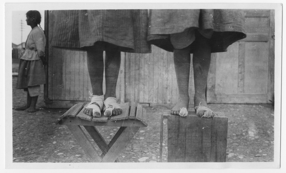 Two children stand with bandaged feet on a stool and a box.